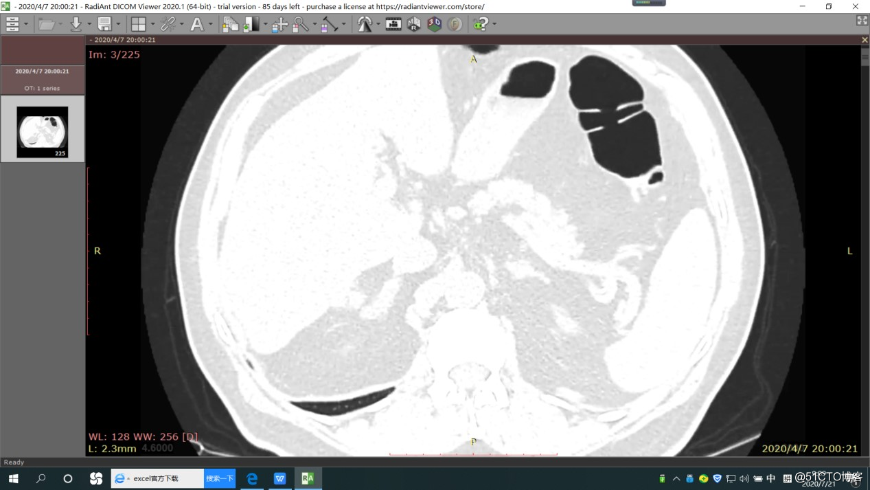 如何利用体测绘技术对新冠肺炎CT数据进行可视化